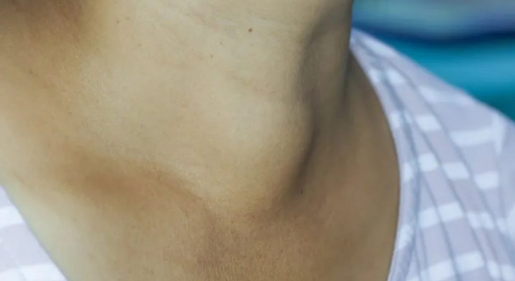 Hyperthyroidism - ayurvedic treatment for cure 3 20250606 050527