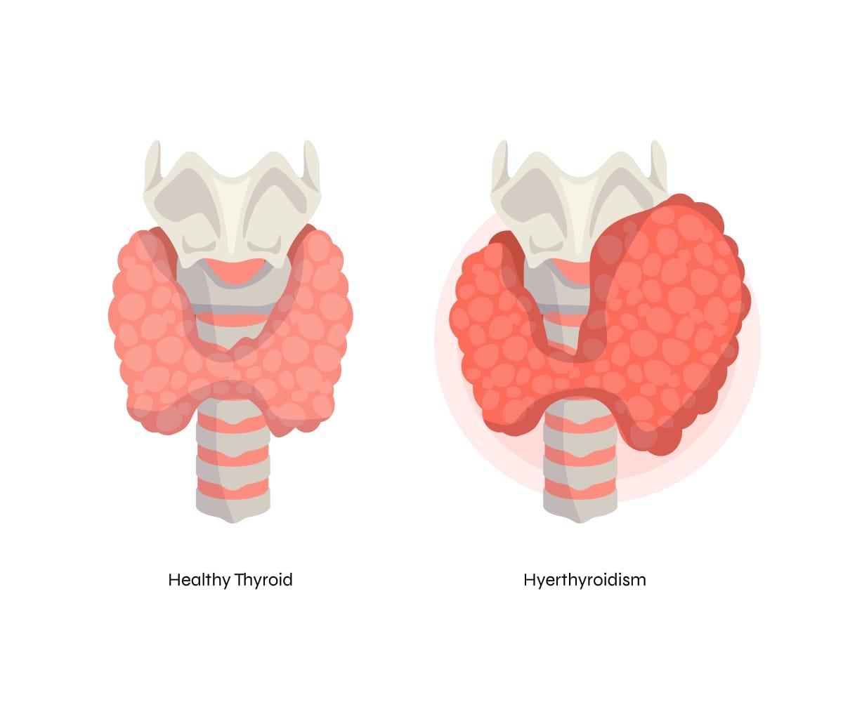 Hyperthyrodism