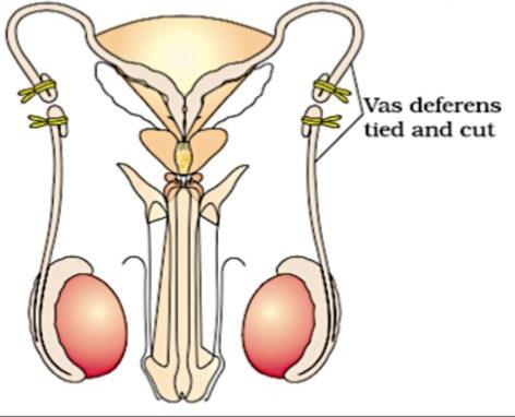 नसबन्दी के पश्चात क्या वीर्य स्खलन, कामेच्छा/Effects of vasectomy on sex drive 1 20240818 151317