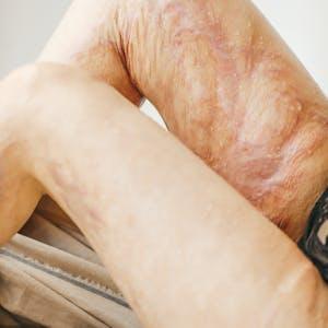 सोरायसिस (Psoriasis) की आयुर्वेदिक चिकित्सा 1 pexels media 17040773 1