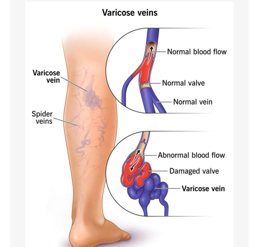 Ayurvedic Varicose Veins treatment 1 20250808 192830